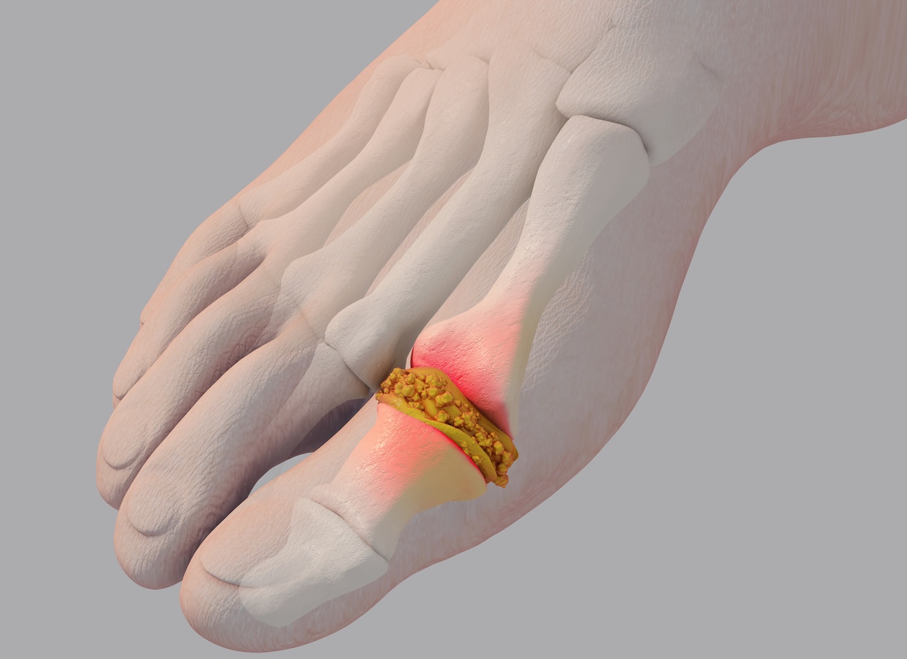 illustration of foot with gout crystals