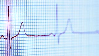 Close-up image of an electrocardiogram (ECG) displaying an irregular heart rhythm