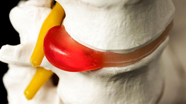 Herniated Disc
