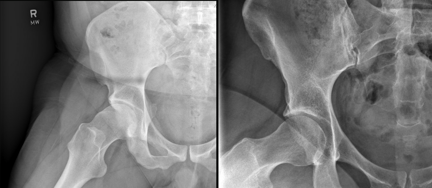 The image on the left shows a right hip with a CAM deformity – extra bone along the femoral neck makes the normally round femoral head less spherical. The image on the right shows a normal right hip, with a more rounded femoral head and a smooth transition between the femoral head and neck.