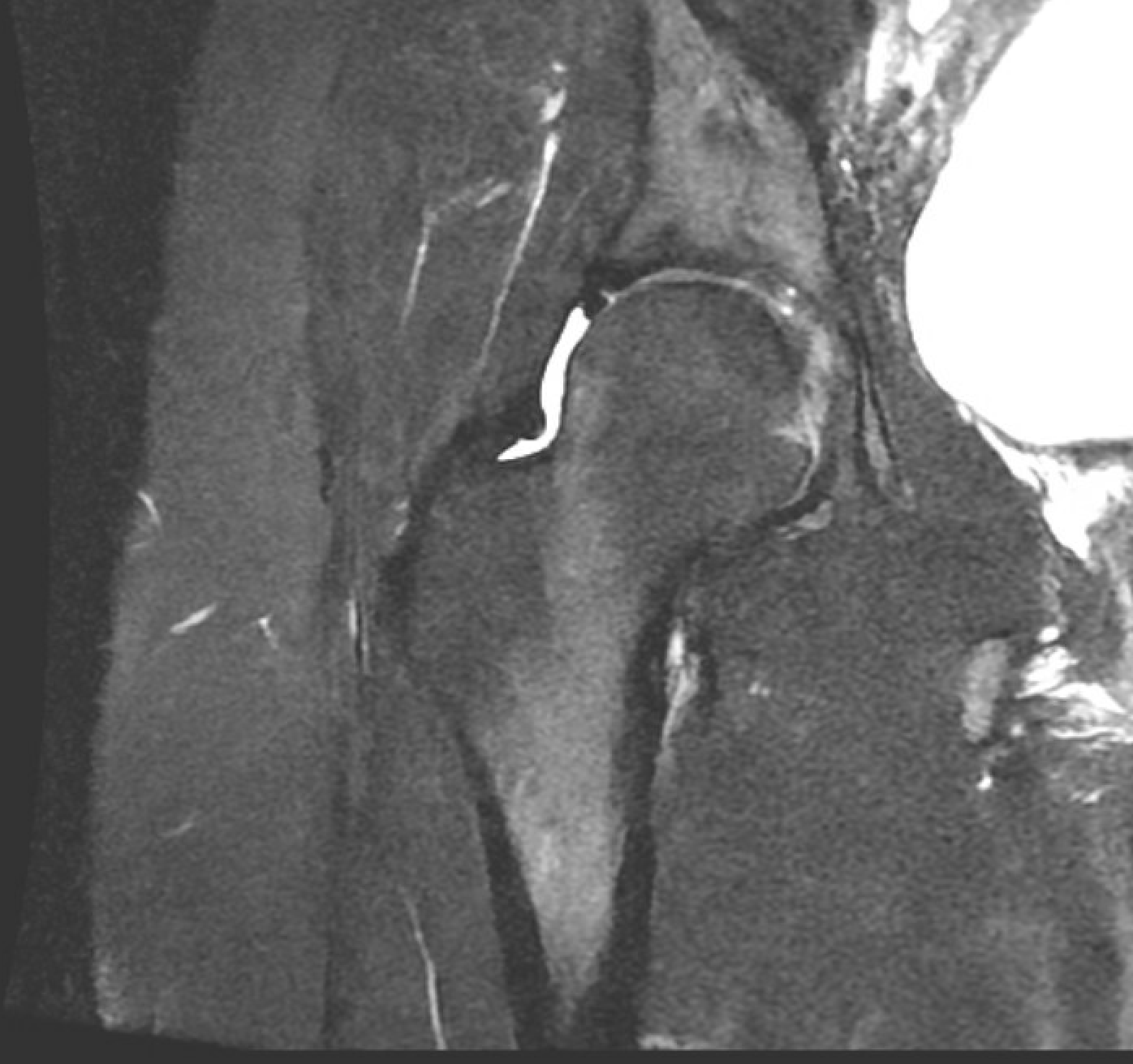 Hip x-ray