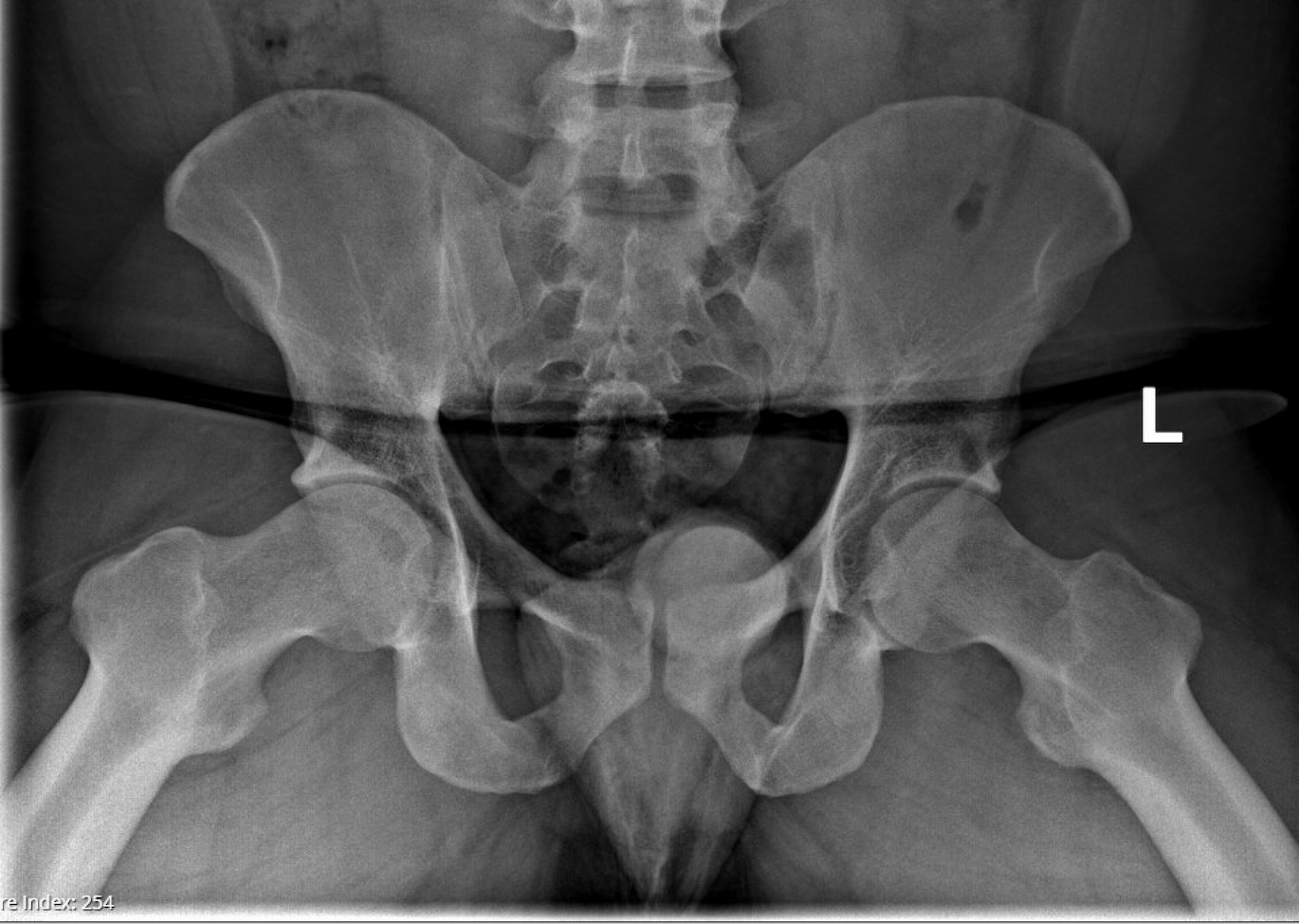 Hip x-ray