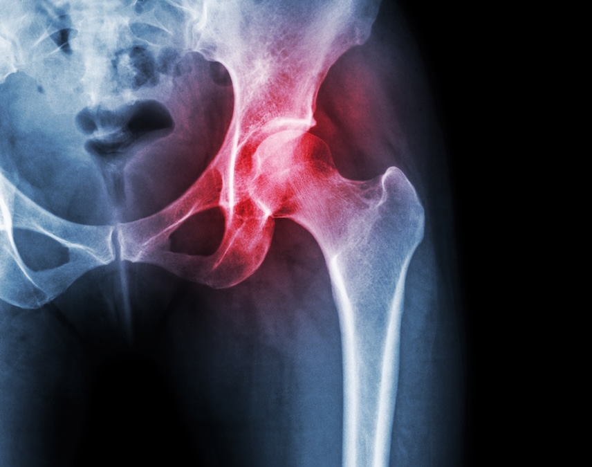 Hip x-ray