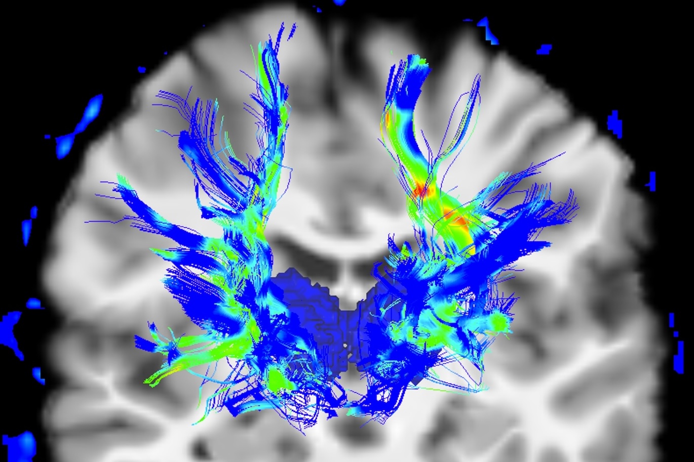 Colorized scan of human brain in Parkinsons disease