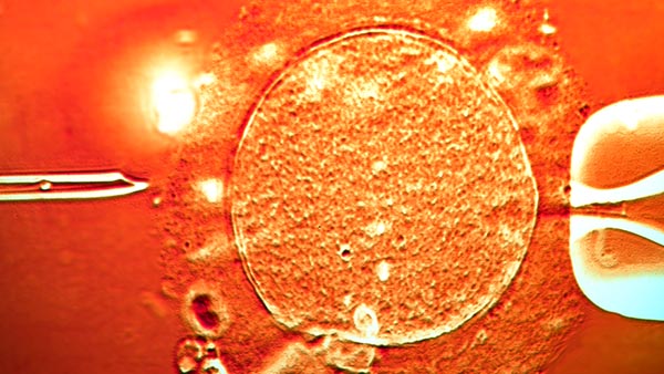 Intracytoplasmic Sperm Injection
