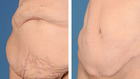 Two images showing a person's abdomen before and after abdominoplasty, with the after photo displaying a smoother and flatter abdominal area.