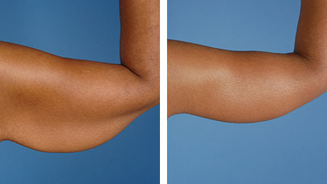 Two images showing an arm before and after an arm lift, with the after photo showing tighter and more toned skin.