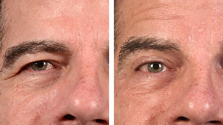 Two close-up images of a man's eyes before and after an eye lift, highlighting a reduction in eyelid sagging and a more youthful appearance.