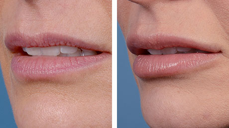 Two side-by-side images showing a close-up of a woman's lips before and after lip enhancement, highlighting increased volume and definition.