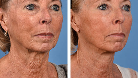 Two images of an older woman showing her neck and lower face before and after a neck lift, demonstrating reduced wrinkles and tighter skin.