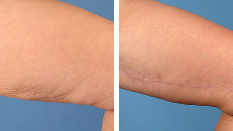 Two images showing a thigh before and after a thight lift, with the after photo displaying smoother and tighter skin.