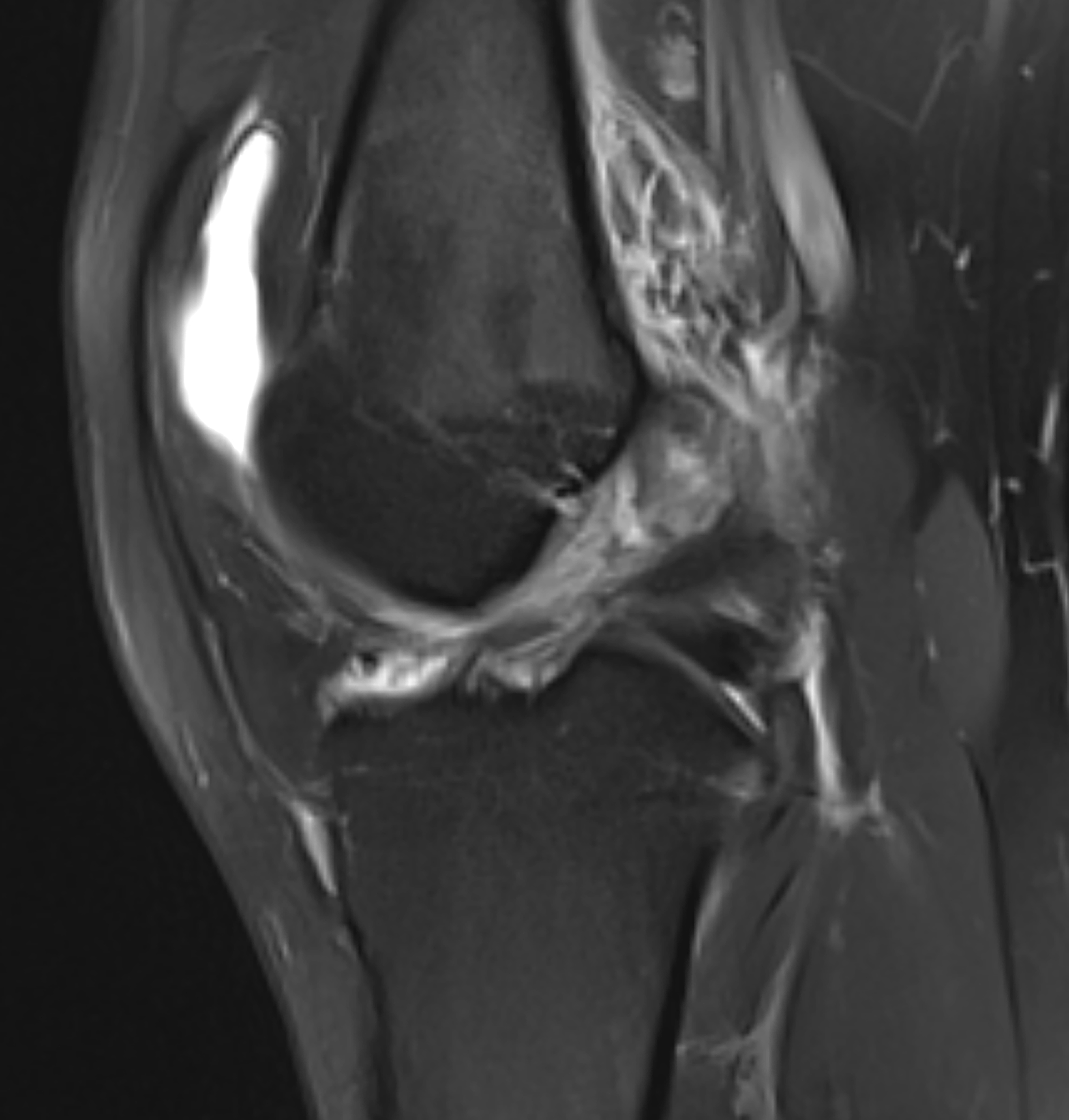 X-ray of ACL injury