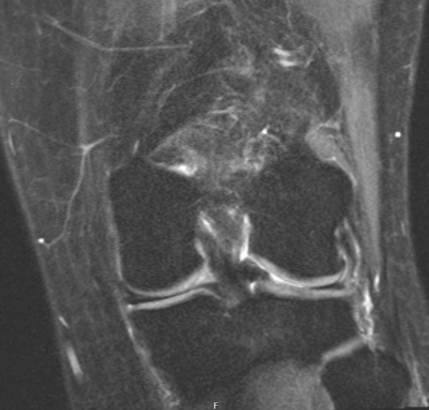 Knee MRI