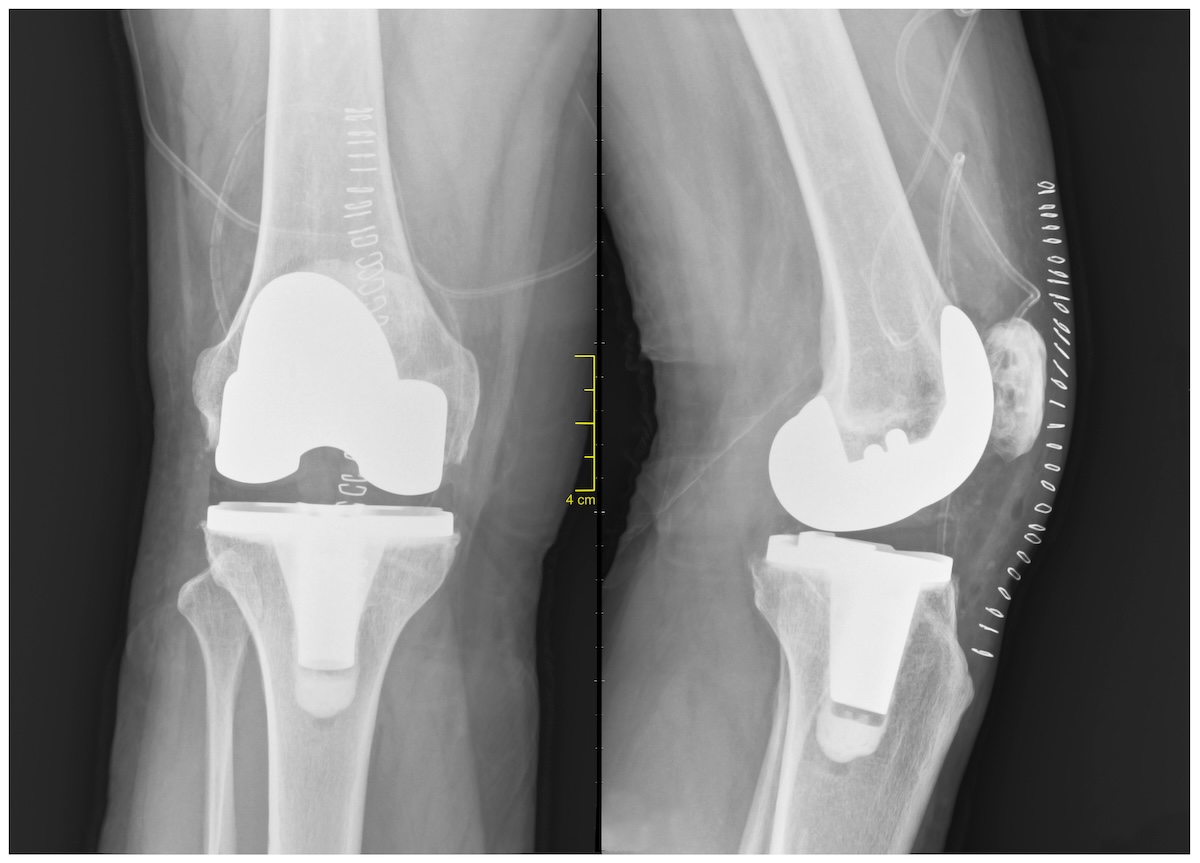 Knee X ray