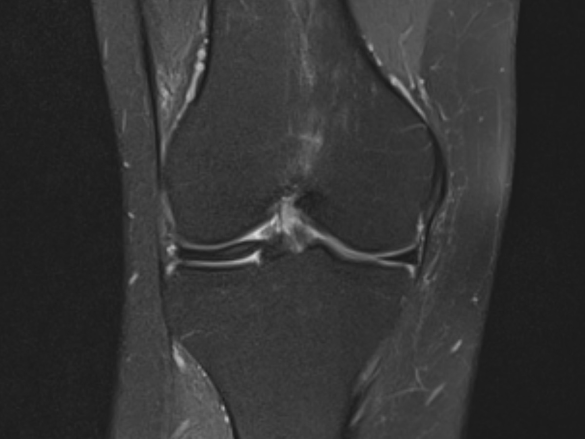 Knee X-ray