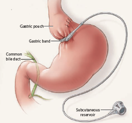 A diagram of the stomach and stomach with Lap-Band.