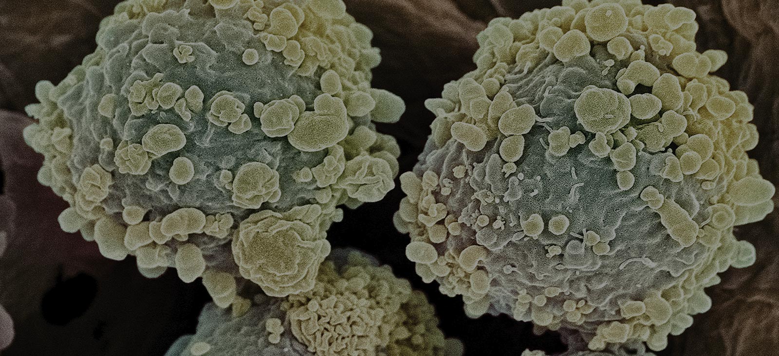 Why Cancer Care Specialization Matters: The Story of Chronic Lymphocytic Leukemia Survivor William Marks