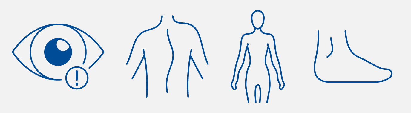 symptoms of Marfan. Dislocation of the eye’s clear lens, leading to blurry or double vision. Tall stature with long arms, legs, fingers, and toes. Curved spine (scoliosis). Flat feet.
