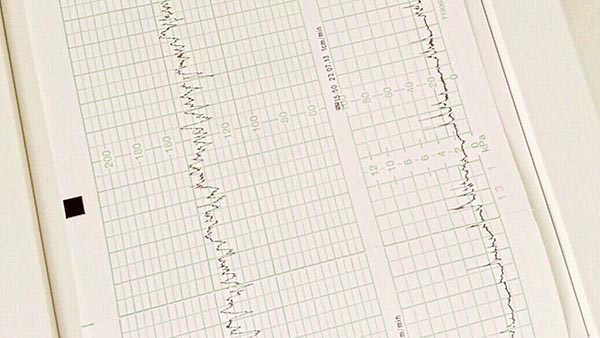 Maze Procedure for Atrial Fibrillation