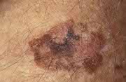 Melanoma on skin with different colors