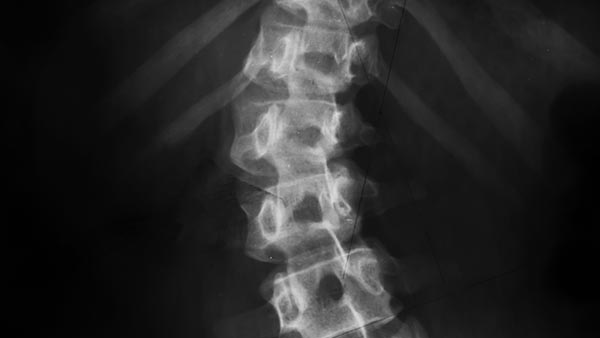 Minimally Invasive Spine Surgery