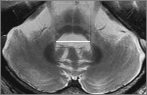 “Hot-cross bun” sign in MSA brain scan