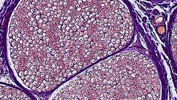 Multiple Sclerosis