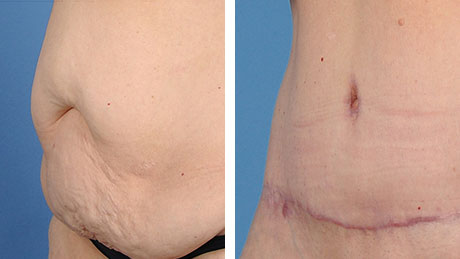 Two images of an abdomen before and after abdominoplasty, with the after photo showing a flatter stomach and a vertical scar along the lower abdomen.