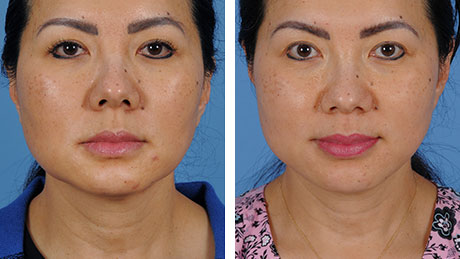 Two front-facing images of a woman before and after neck liposuction procedures, highlighting improved symmetry and skin texture.