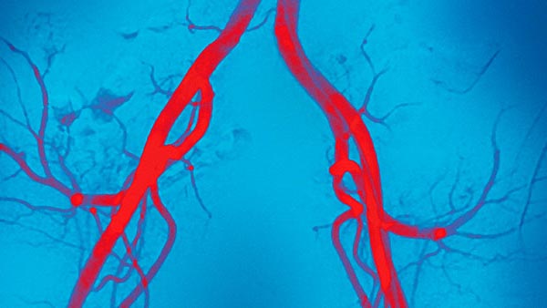 Narrowed Blood Vessels