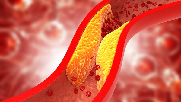 Illustration showing narrowed blood vessels
