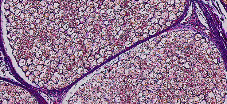 Neurofibromatosis