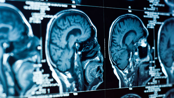 Multiple brain MRI scans are displayed side by side, showing cross-sectional views of a human brain in shades of blue and white.