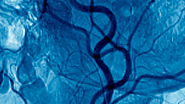 Noninvasive Vascular Imaging