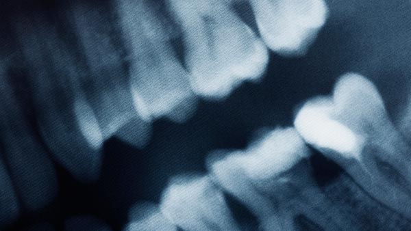 Oral Surgery and Wisdom Teeth