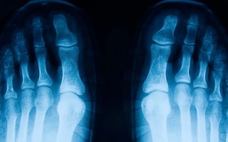 x-ray of two feet