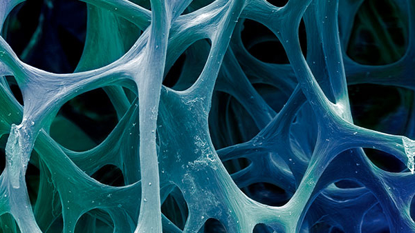 Osteogenesis Imperfecta