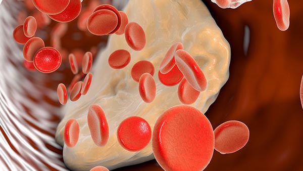Peripheral Artery Disease