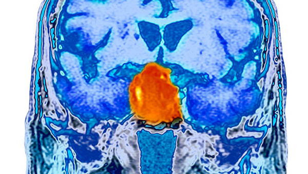 Pituitary Adenoma scan