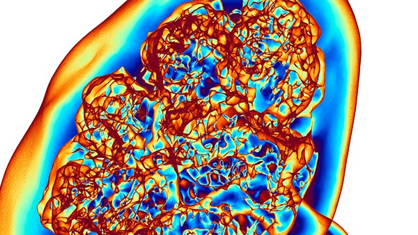 Polycystic Kidney Disease