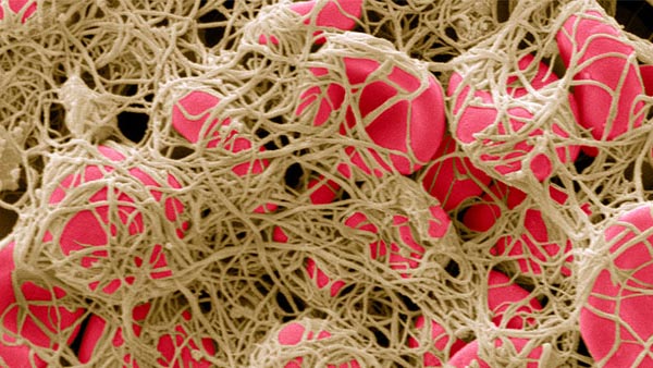 Portal Vein Hypertension