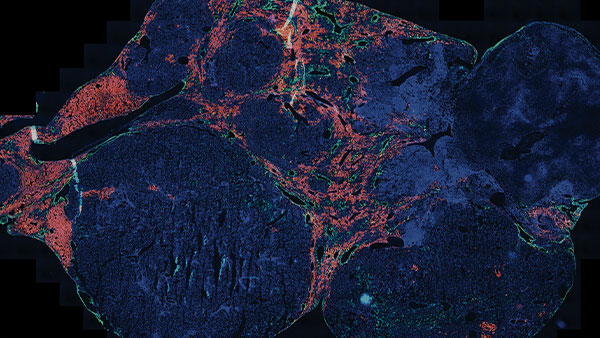 Demystifying Tumor Biology of Hepatocellular Carcinoma