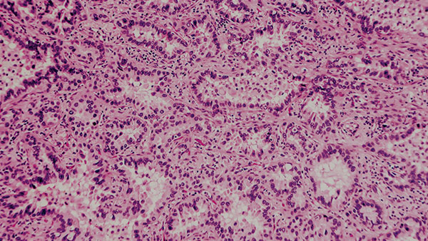 Novel Drug Combination Fights Resistance to TKI Therapy