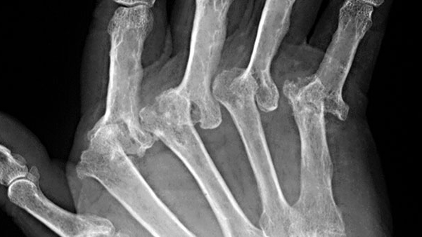 Rheumatoid Arthritis