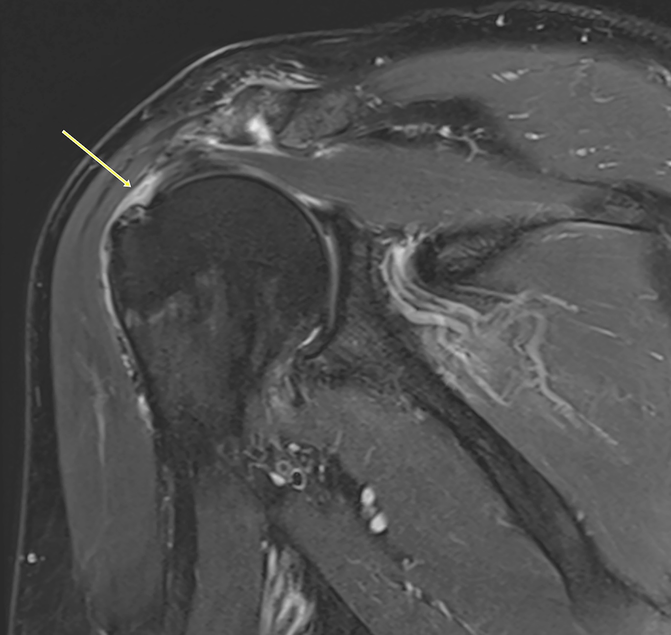 Rotator cuff MRI