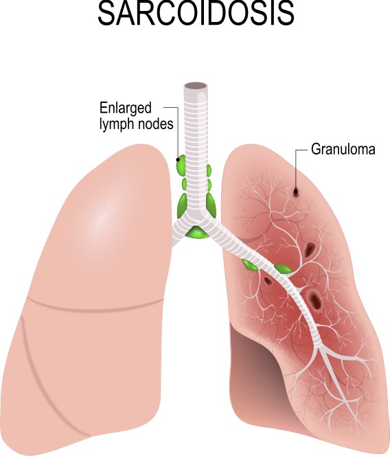 Medical illustration of enlarged lymph nodes and granuloma