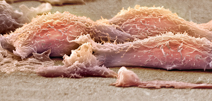 Sarcoma