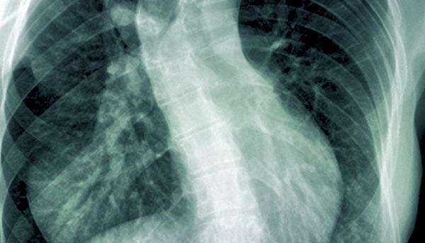 Scoliosis and Spinal Deformities