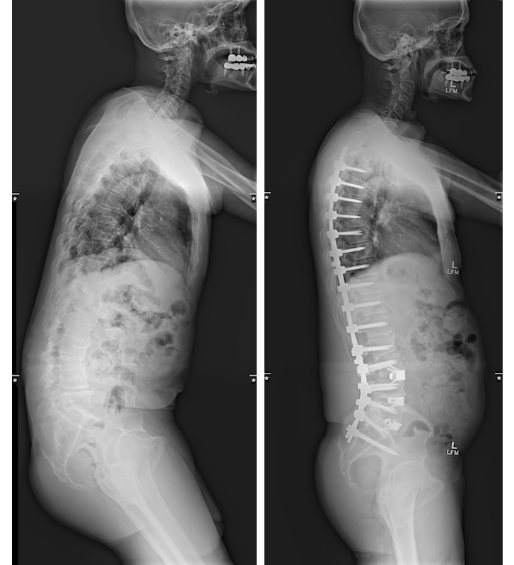 Scans of a person before and after scoliosis treatment