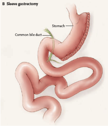 Diagram of Sleeve Gastrectomy.